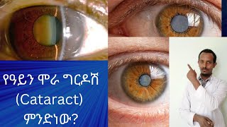 የዓይን ሞራ ግርዶሽ ምንድነው?/What is cataract?