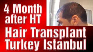 Hair Transplant 4 Month Update Romeo Hair transplant Journey