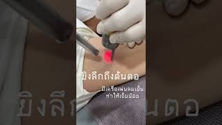 เลเซอร์กำจัดขนรักแร้ ND - Yag laser