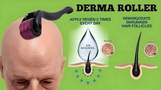 1 MM Derma roller and Minoxidil for hair regrowth Results | 2% ketoconazole shampoos for Alopecia