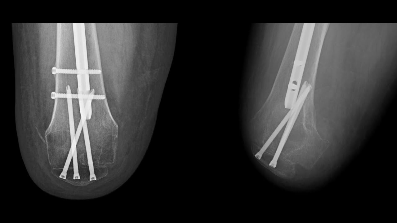 Knee Disarticulation Amputation - Professor Munjed Al Muderis ...