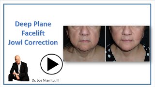 Deep Plane Facelift For Jowl Improvement Shorts