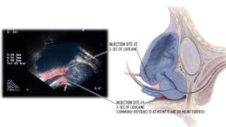 Modified Periprostatic Nerve Block Procedure