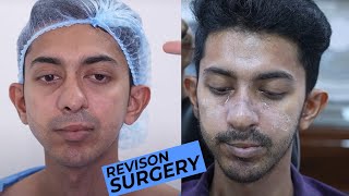 Very Challenging Re-Re-Re-Revision Rhinoplasty Surgery | Full Surgery with Result