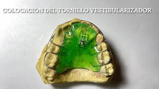 Colocación del tornillo de acción transversal sagital/vestibularizador.