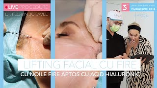 NOUTATE!  Lifting Facial cu noile fire Aptos: Live procedure - Dr. Juravle !