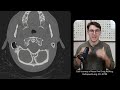 skull base foramina radiology anatomy part 1 prep ct imaging of skull base