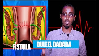 Nabro Dabada oo Babaasiirka lagu Qaldo (Anal fistula)