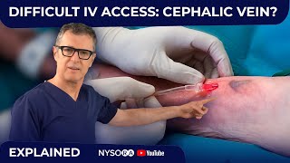 Difficult IV access: Cephalic Vein?