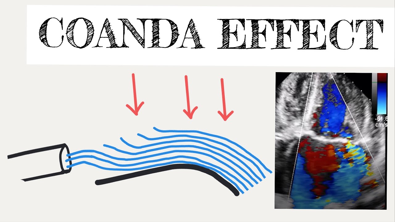 Coanda Effect In Cardiology - YouTube