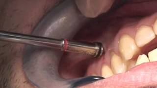 OrthoEasy - Removal of pin vestibular in maxilla