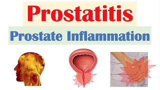 Prostatitis (Prostate Inflammation): Different Types, Causes, Signs & Symptoms, Diagnosis, Treatment