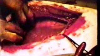 Surgical Removal of a Unilocular Hydatid Cyst Part 1