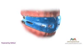 Life with Braces - Wearing Sport Mouthguard