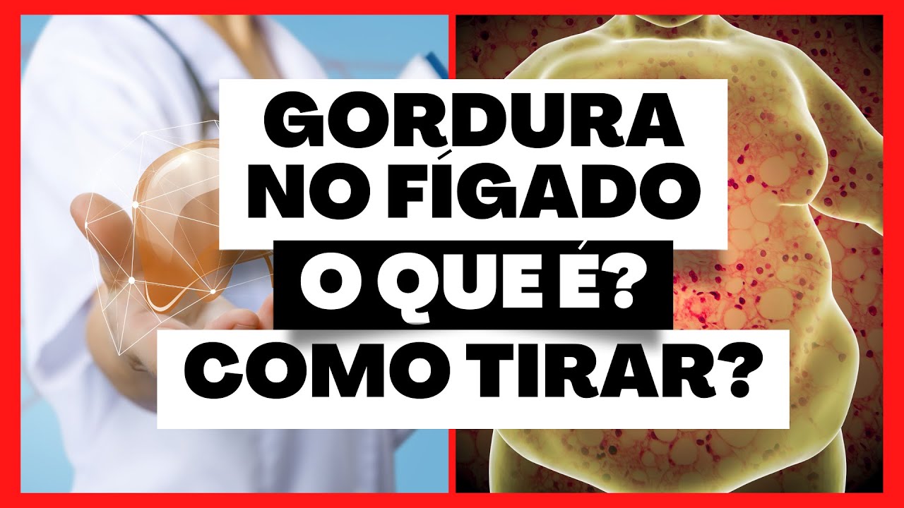 Os 15 SINAIS De GORDURA NO FÍGADO (esteatose Hepática), Como ELIMINAR ...