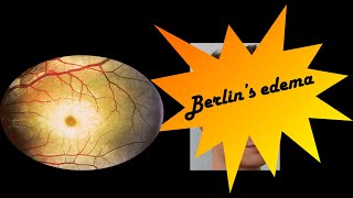 Berlin's edema | Commotio retinae