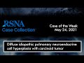 Case of the Week: Diffuse idiopathic pulmonary neuroendocrine cell hyperplasia with carcinoid tumor