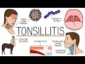 Understanding Tonsillitis