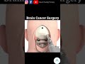 Brain tumor/cancer surgery #shorts