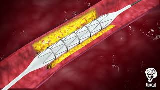 قسطرة شرايين القلب: كيف يتم؟ وكيف يساعد في العلاج والتشخيص؟