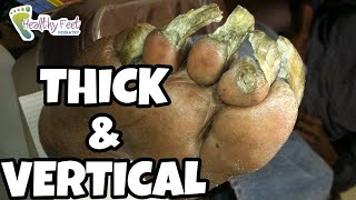 CUTTING SEVERE THICK NAILS, HOW TO CUT THICK TOENAILS, FUNGUS IN TOENAILS, FUNGAL NAIL CURE