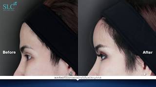 ศัลยกรรมเสริมซิลิโคนหน้าผาก Forehead Augmentation BY SLC หน้าผากสวย