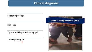 Spastic Diplegic Cerebral Palsy || Spot Diagnosis - 7 || Pediatrics