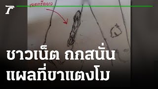 ชาวเน็ต ถกสนั่น แผลแตงโมอาจโดนแก้วไวน์ | 21-03-65 | ข่าวเช้าหัวเขียว