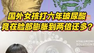 国外女孩打六年玻尿酸，竟在脸部膨胀到两倍还多？ 全分子量玻尿酸