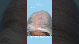 Combat female hair thinning with PRP injections. This patient had 2 PRP sessions and 1 Exosomes!