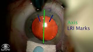 Limbal Relaxing Incision (LRI) Example