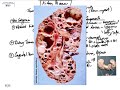 kidney 1