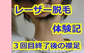 レーザー脱毛体験談！襟足脱毛3回目動画YouTube