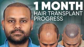 Hair Transplant in Jodhpur | Best Results \u0026 Cost of Hair Transplant in Jodhpur