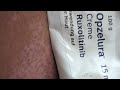 23 Tage Anwendung Opzelura Ruxolitinib Vitiligo Creme - erste Ergebnisse