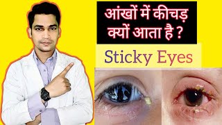 आंख में कीचड़ आने का कारण क्या है | Aankh Mein Khichad Aane Ka Karan | Eyecare Expert