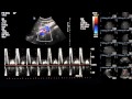 ultrasound physics explaining doppler