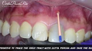 Tracing Sinus Tract With Gutta Percha Point TAKEN WITH XRAY IMAGE