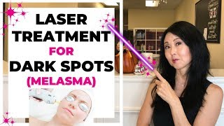 Laser Treatment for Dark Spots Melasma