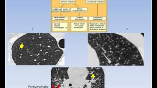 CT CHEST BASICS