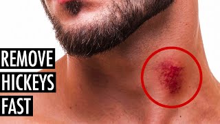 Best Ways to Get Rid of or Hide a Hickey | Remove a Hickey Fast | Tiege Hanley
