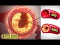 Just 3 Ingredients Will Unclog Your Arteries Without Medication and Reduce Cholesterol Fast Just 3 Ingredients Will Unclog Your Arteries Without Medication and Reduce Cholesterol Fast