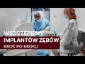 JAK PRZEBIEGA ZABIEG WSZCZEPIENIA IMPLANTÓW ZĘBOWYCH? l STOMATOLOGIA DANUTA BORCZYK