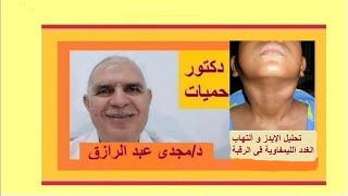 تحليل الإيدز و ألتهاب الغدد الليمفاوية فى الرقبة | HIV test