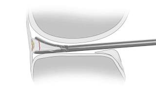 Animation of Ceterix meniscus repair - Justin Saliman MD