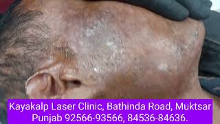 Surat Gujarat Burn Scar Combination Treatment | Best Laser Treatment in India | 6 in1 Treatment.