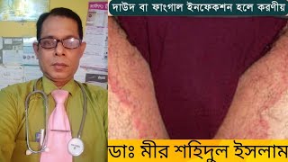 ডার্মাটোফাইটোসিস কি? কেনো হয় এই রোগ।এই রোগের কারণ লক্ষন ও চিকিৎসা সম্পর্কে সংক্ষিপ্ত আলোচনা।পার্ট ২