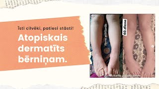 Atopiskais dermatīts. Pieredze, atsauksme.