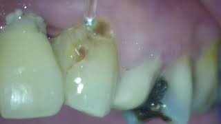 Decay removal using Fotona LightWalker without anaesthetic