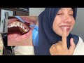 Pasang BEHEL di Dokter umum dental worth it gak sih? JANGAN SALAH PILIH BEHEL